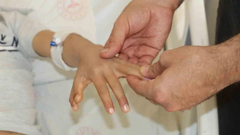 Şırnak'ta Yapışık Parmaklı Kardeşler Ameliyat Oldu