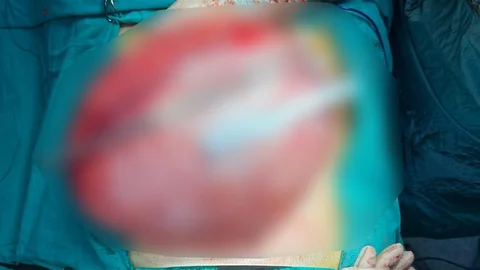 Bolu'da Hastaneye Giden Çocuğun Karnında Kist Bulundu