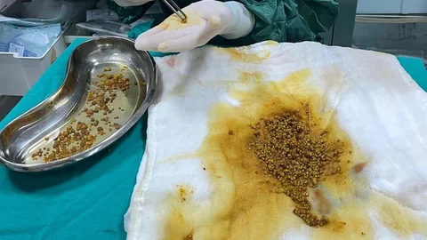 Bingöl'de Safra Kesesinden 2 Bin 67 Taş Çıkarıldı