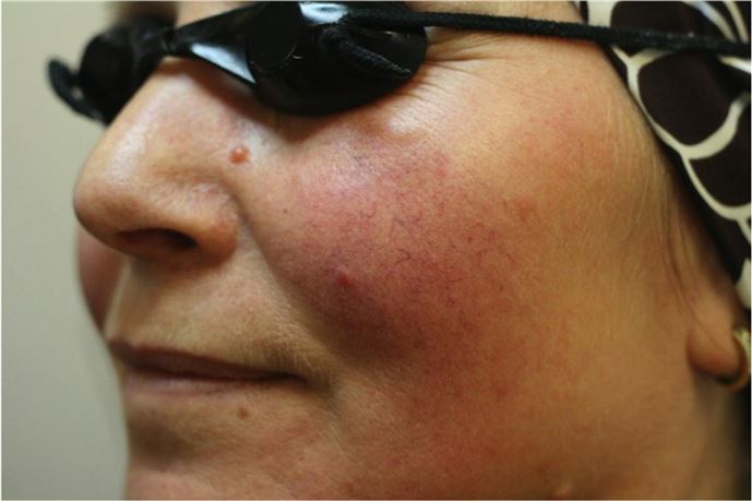 Kılcal damar genişlemeleri varisin habercisi