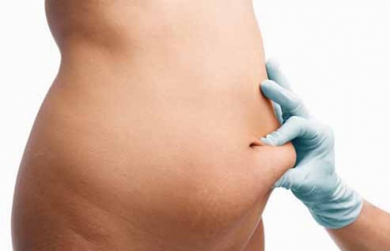 Hamilelik Sonrası Vücut Bozukluğu