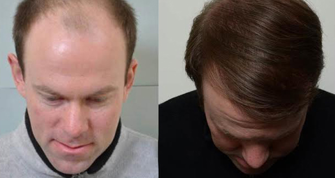 İstanbul'da Saç Dökülmesine Karşı Organik Enjeksiyon Yöntemi Uygulanıyor