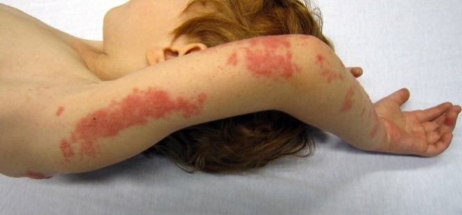 Servergazi'de Cilt Sağlığı için Önemli Uyarılar