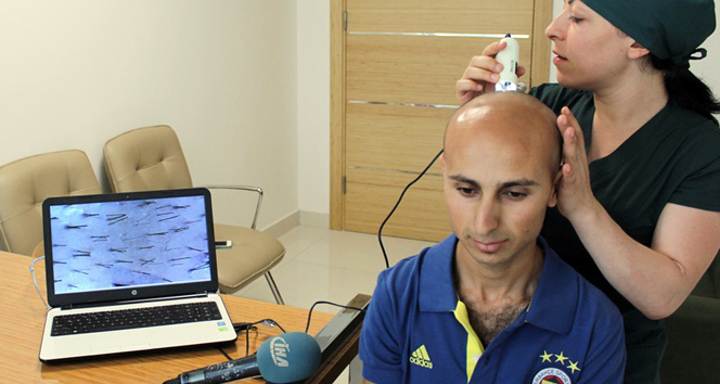 İzmir Bornova'da Saç Ekimi Yaptıran Onur Sevinç, 7 Yıldır Saçsızdı