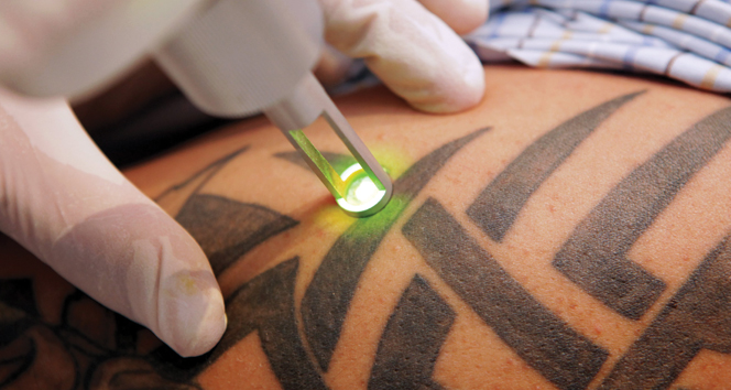 Dövmelerden Kurtulmak İçin Lazerle Silme Yöntemi Kullanılıyor