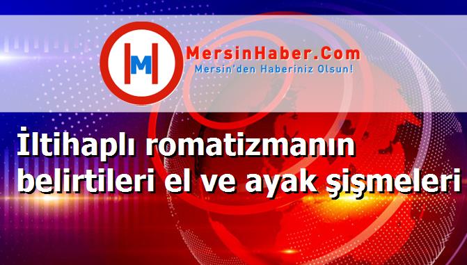 İltihaplı romatizmanın belirtileri el ve ayak şişmeleri