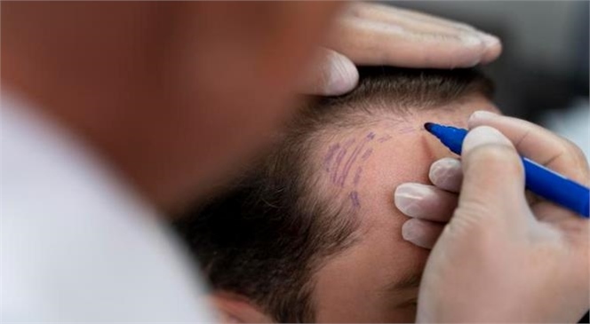 Erkek Tipi Saç Dökülmesine Etken Çözüm: Saç Ekimi
