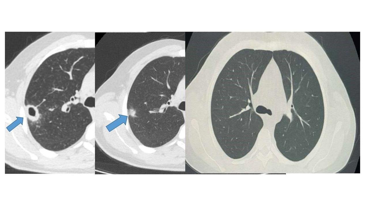 Bayburt'ta Erken Tanı ile Sağlığına Kavuşan Hasta