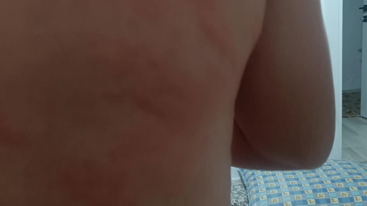 Elazığ'da Böcek Isırığı Hastanelik Etti