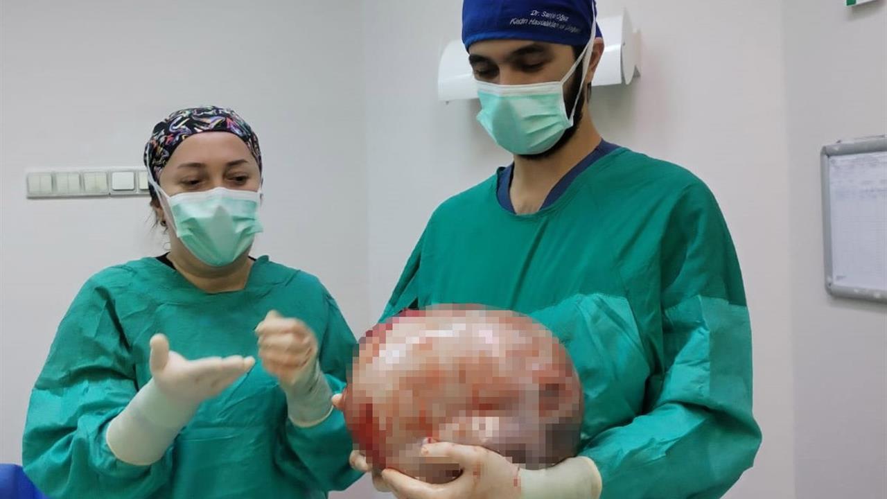 Amasya Göynücek'te 2 Ayda 9 Aylık Hamile Gibi Büyüyen Kadının Karnından 8,5 Kiloluk Kitle Çıkarıldı