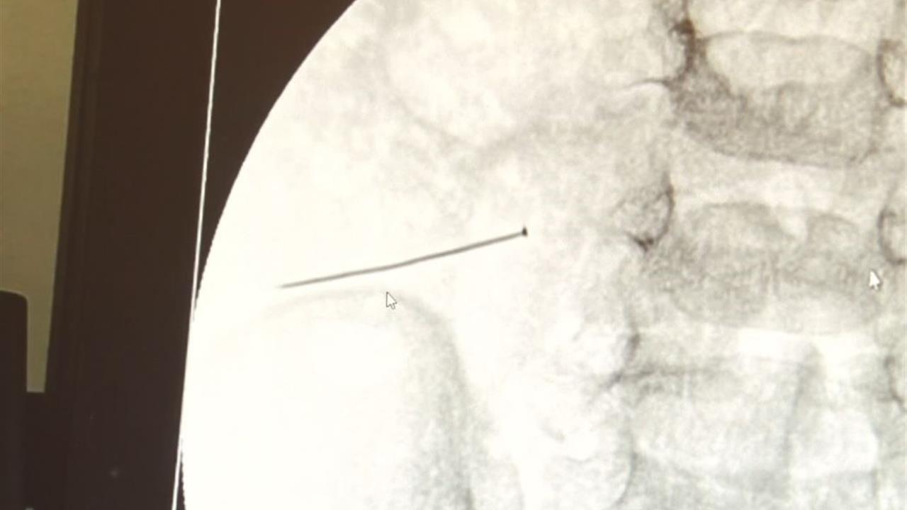 İstanbul'da 2 Yaşındaki Çocuğun Bağırsağında 3 Santimlik İğne Bulundu