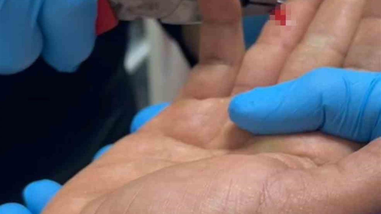 Adıyaman Kahta'da Balık Avlarken Parmağına Saplanan İğne İtfaiye Tarafından Çıkartıldı