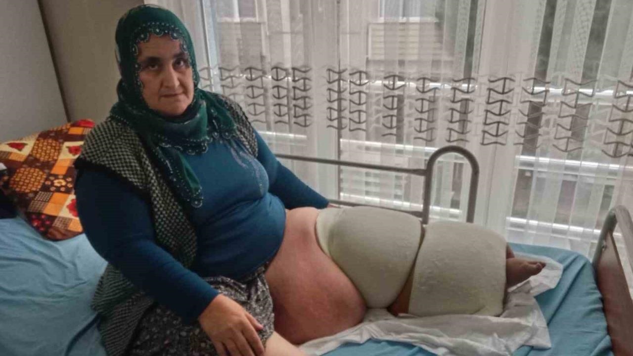 35 Yıldır Fil Hastalığıyla Savaşan Tarsuslu Cennet Teyze: " Yeniden Yürüyebilmek İçin Destek Bekliyorum "